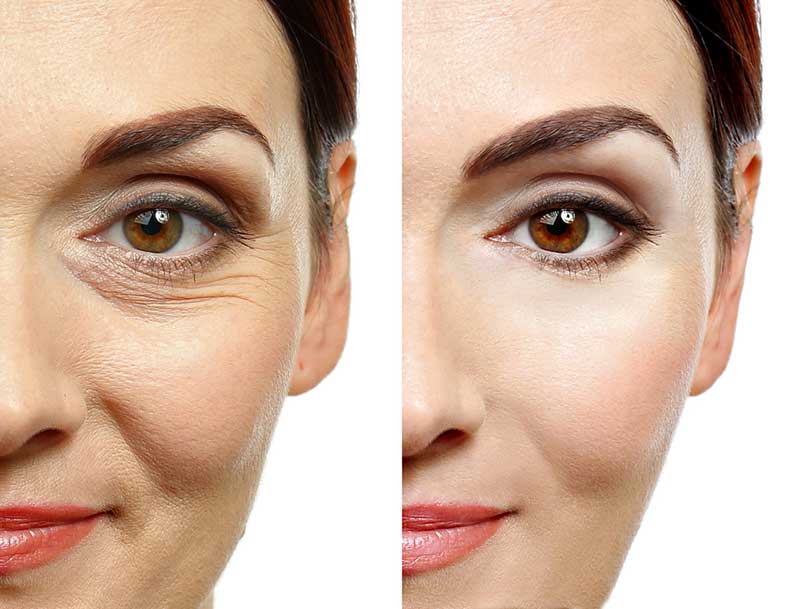 best treatment for under eye wrinkles