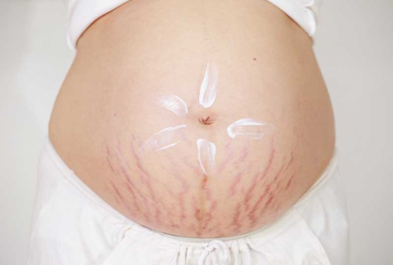 best stretch mark prevention cream during pregnancy